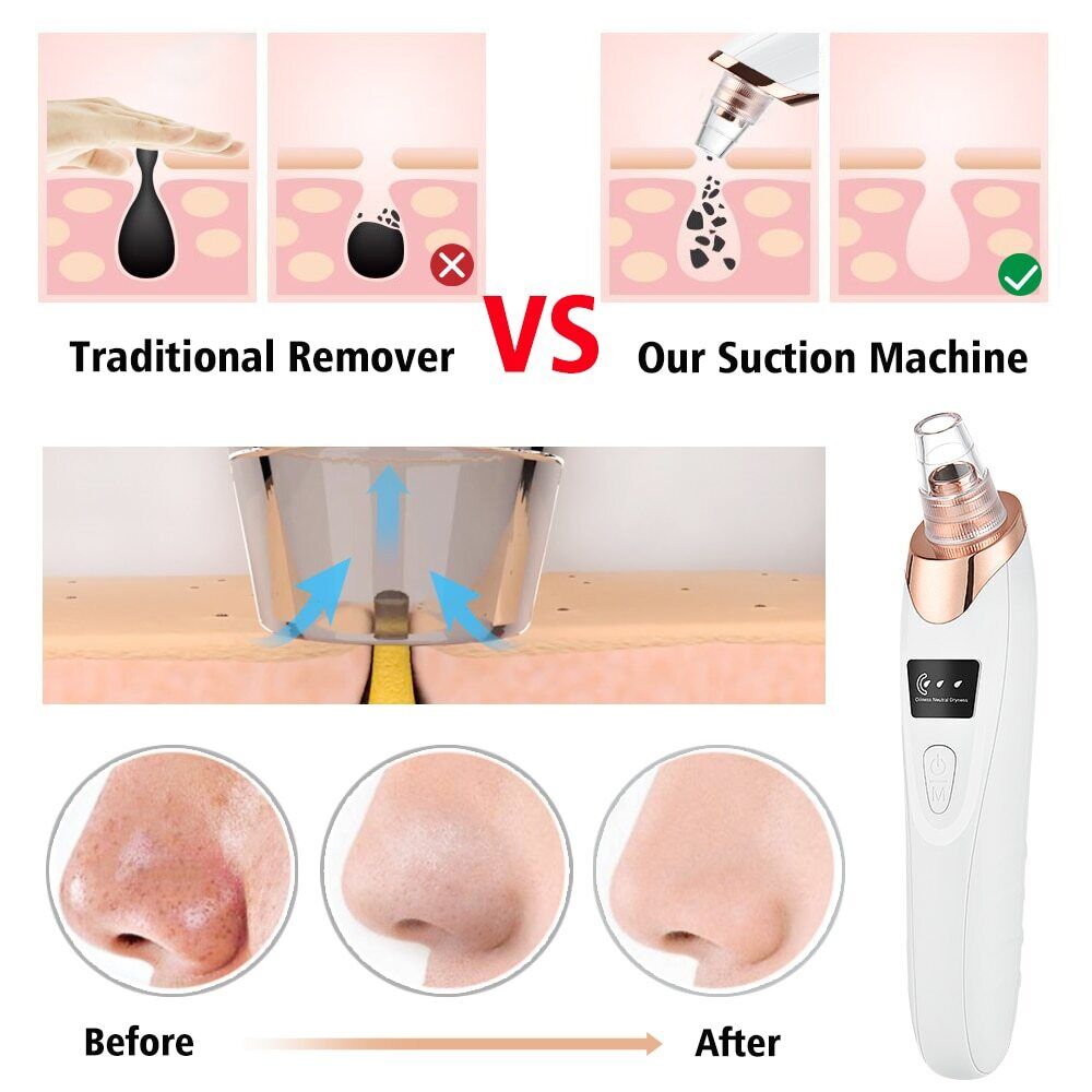 "Electric Blackhead Remover Pore Vacuum | 5-Speed Suction, LED Display, Deep Facial Cleaning & Skin Care Tool"